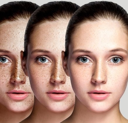 Pigment treatment at Mandarin Spa Nijmegen Uden